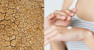 3 Easy Tips To Heal Your Dry Winter Skin Quick
